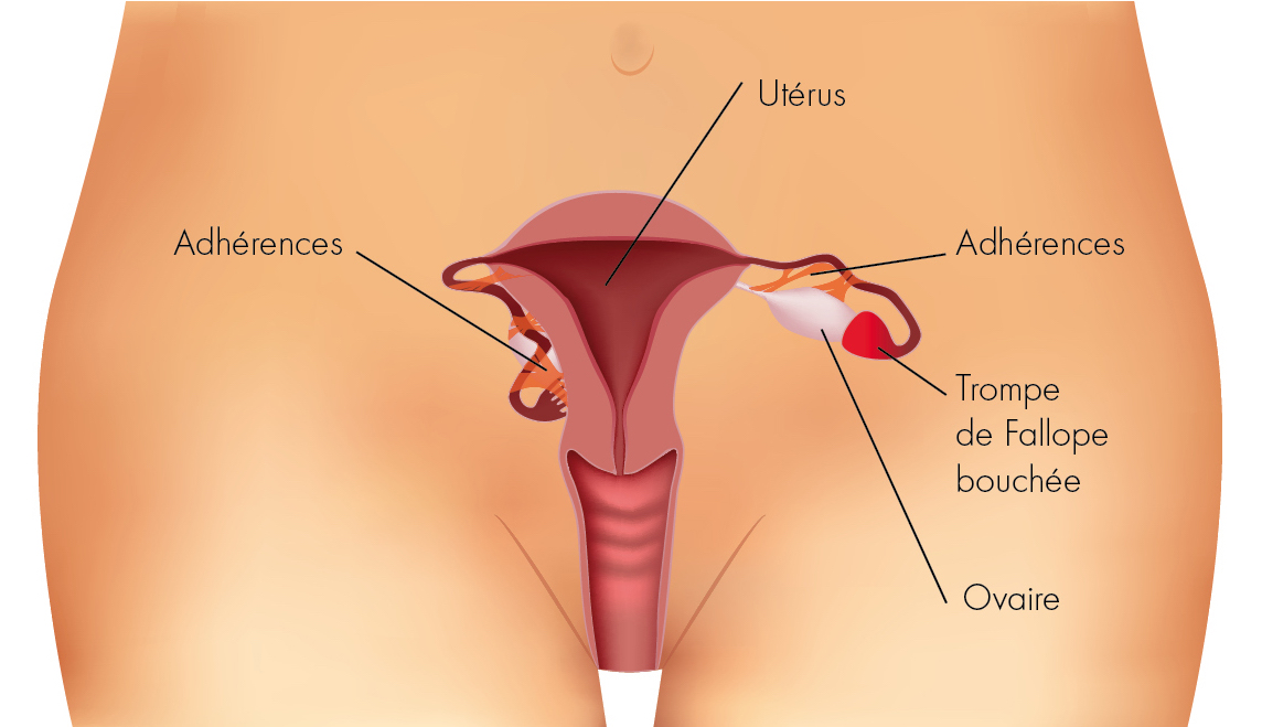 Malformations de l'utérus : une grossesse reste possible
